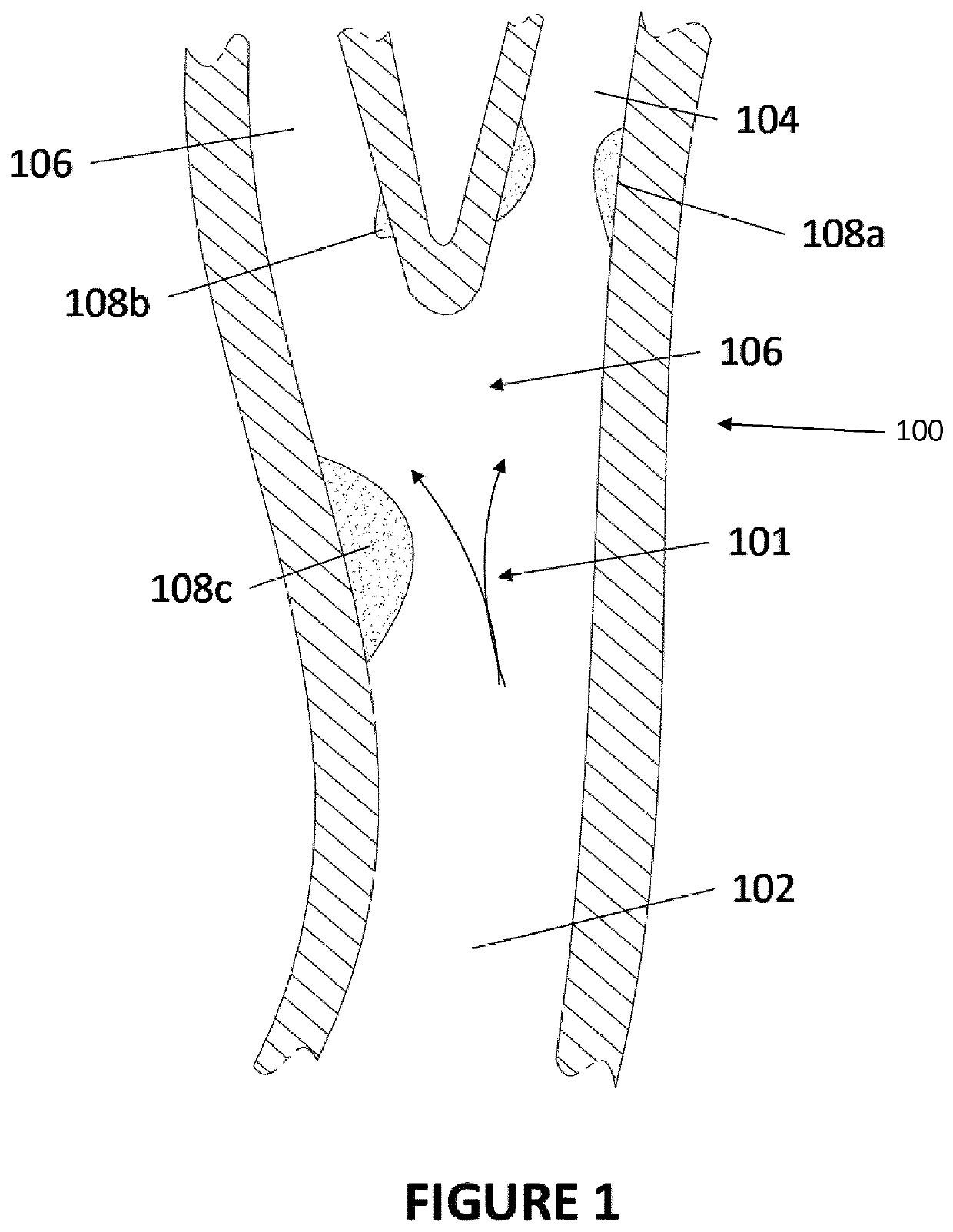 Stent and Catheter Systems for Treatment of Unstable Plaque and Cerebral Aneurysm
