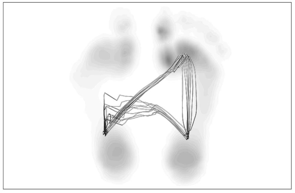 A method for evaluating gait patterns in patients with unilateral Achilles tendon rupture during rehabilitation