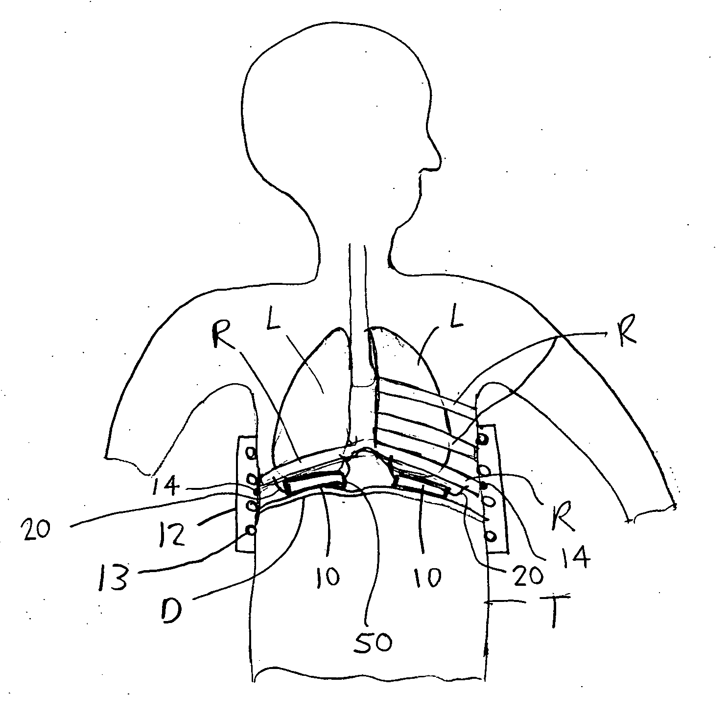 Electromagnetic diaphragm assist device and method for assisting a diaphragm function