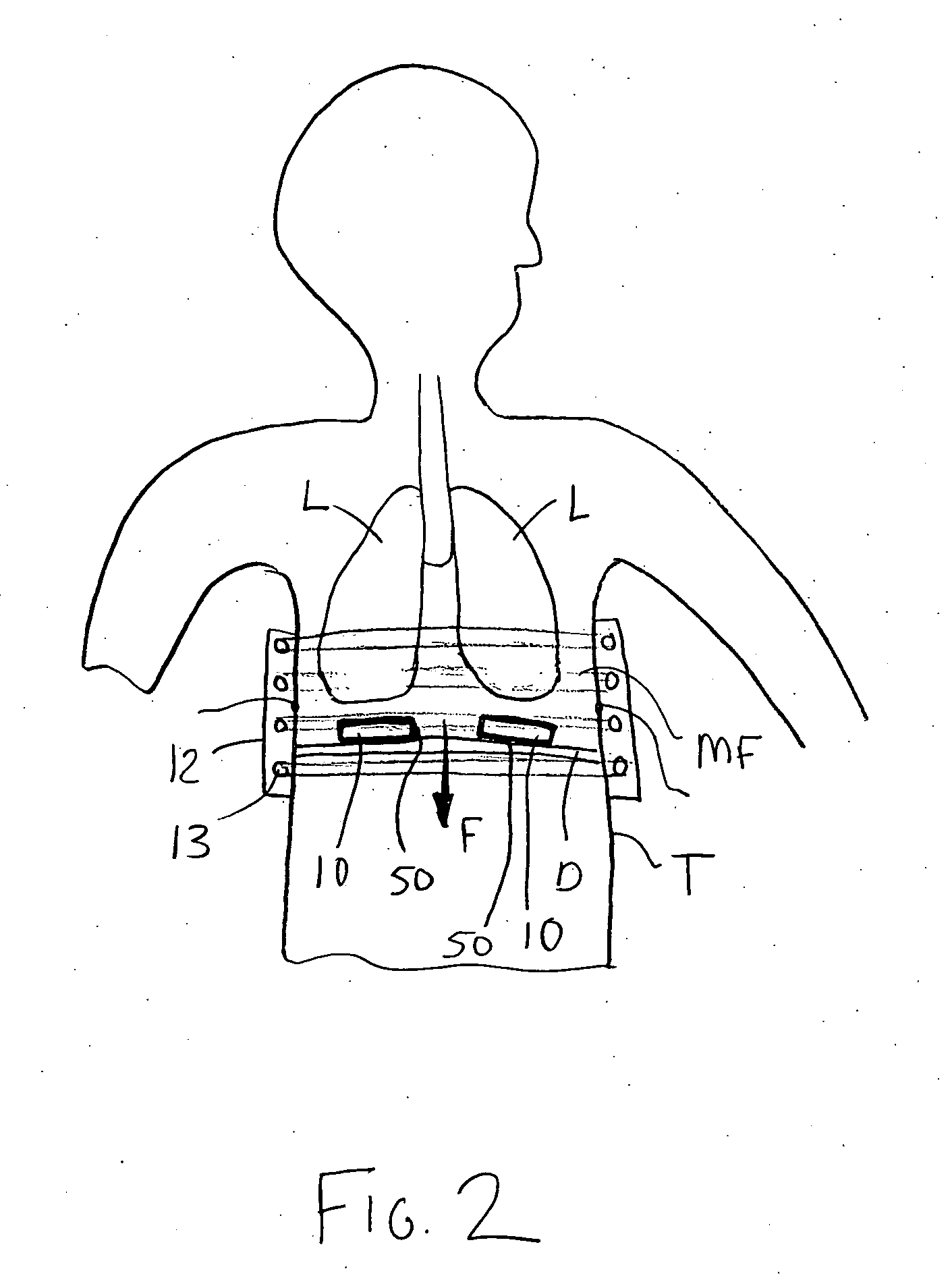 Electromagnetic diaphragm assist device and method for assisting a diaphragm function