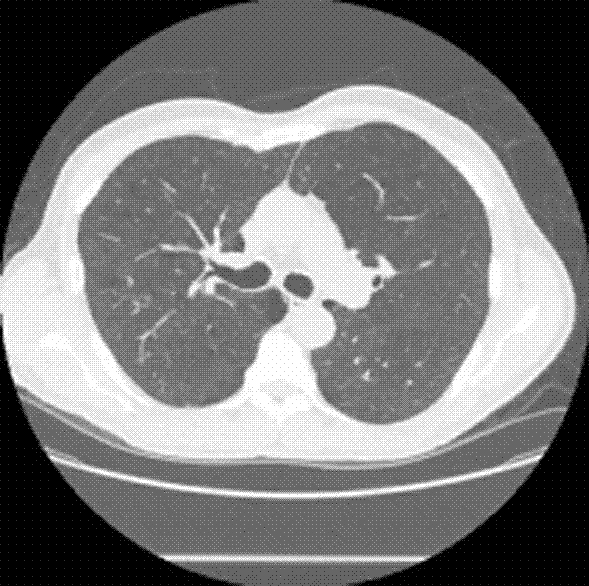 Lung parenchyma area surface model establishment method based on computed tomography (CT) image