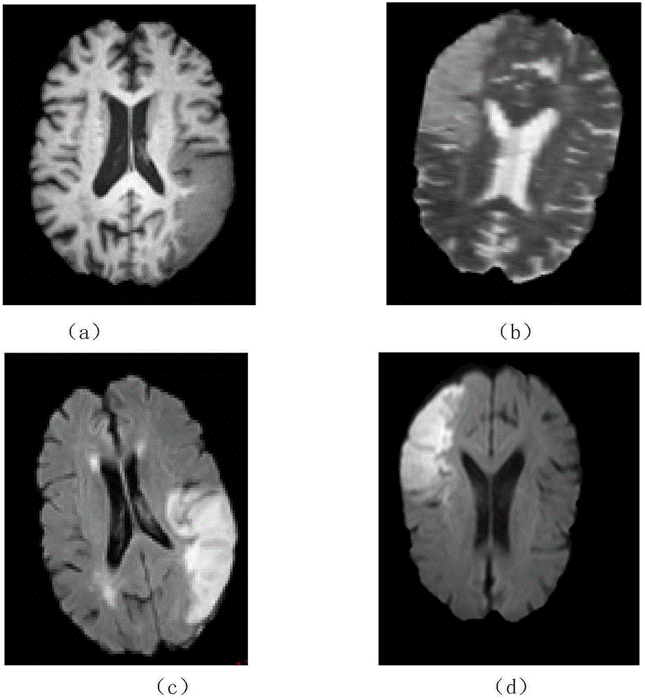 Multi-modal brain-image injured pathological tissue image segmentation method