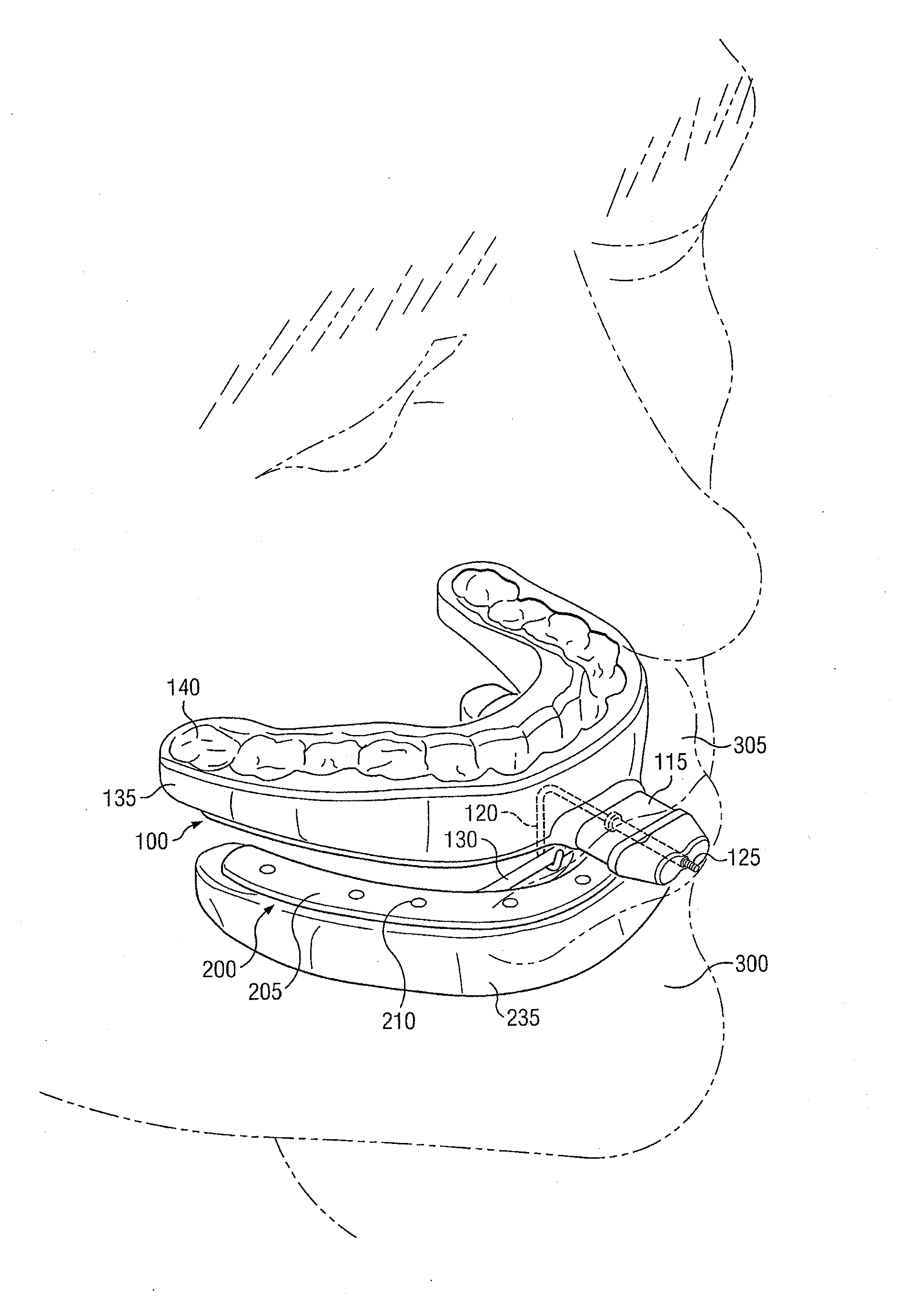 Universal oral appliance with a universal coupler