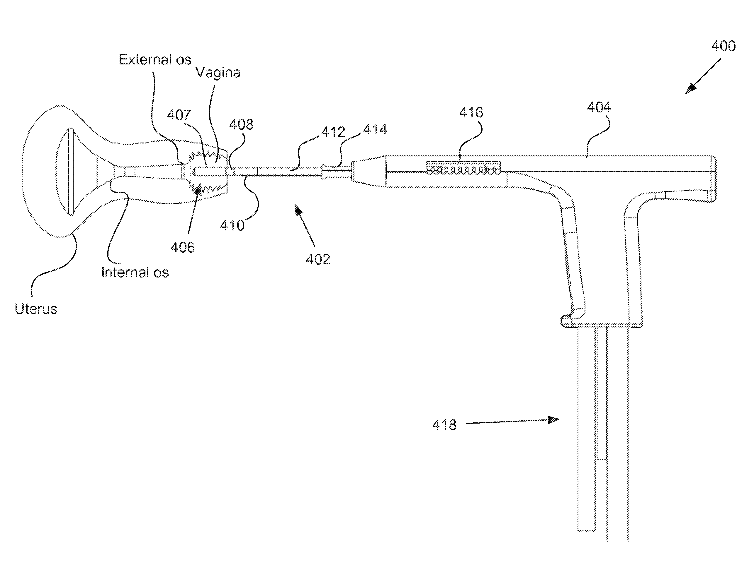 Positioning Method and Apparatus for Delivering Vapor to the Uterus