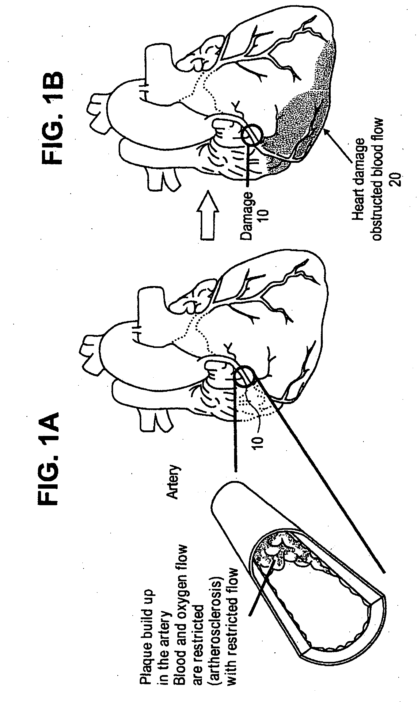 Methods and compositions for treating post-cardial infarction damage