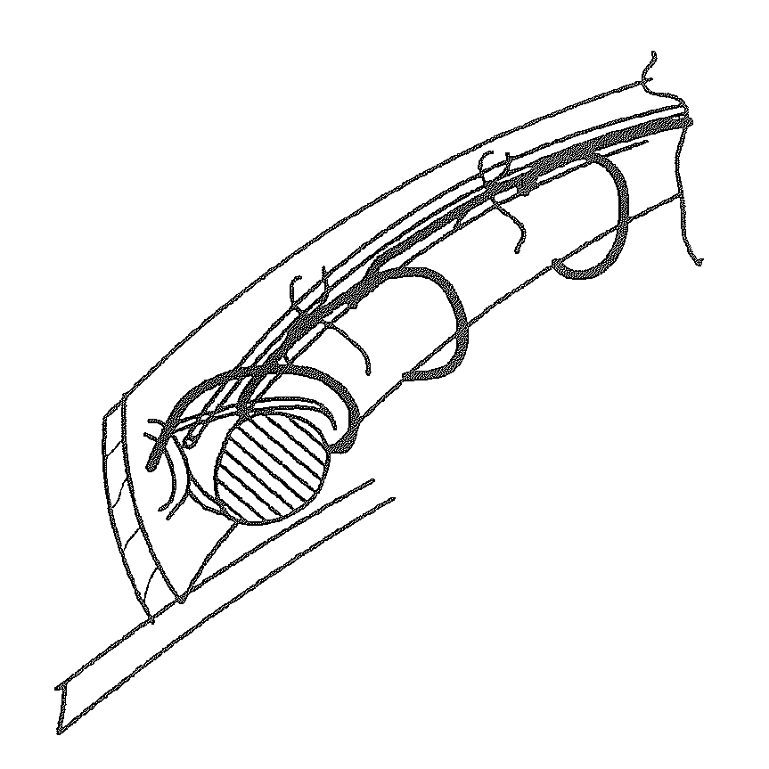 Delivery Device for Medical Implant and Medical Procedure