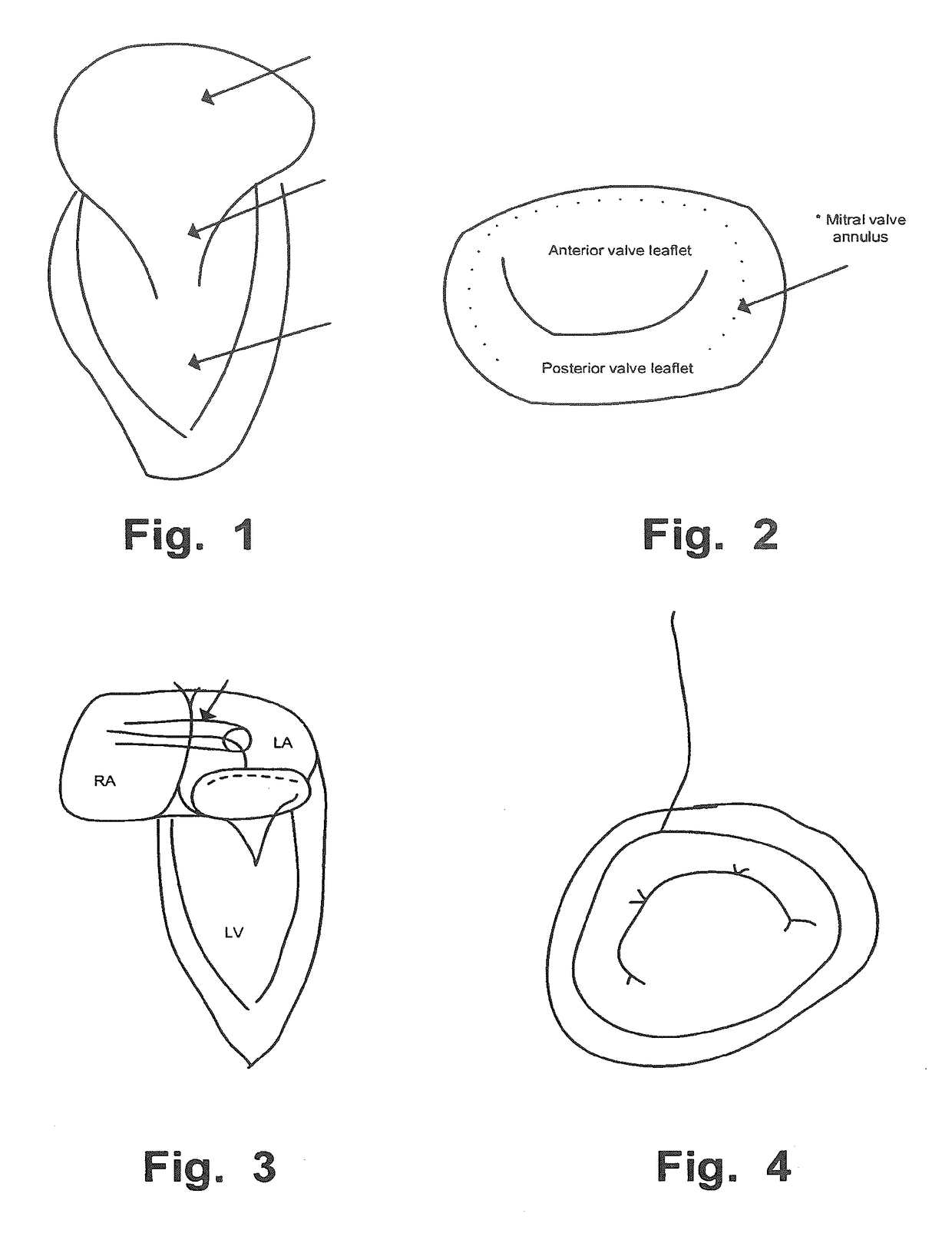 Delivery Device for Medical Implant and Medical Procedure