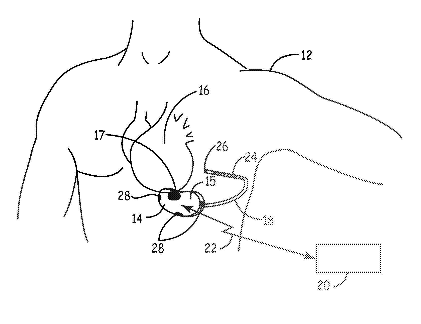 Method and apparatus for verifying a determined cardiac event in a medical device based on detected variation in hemodynamic status