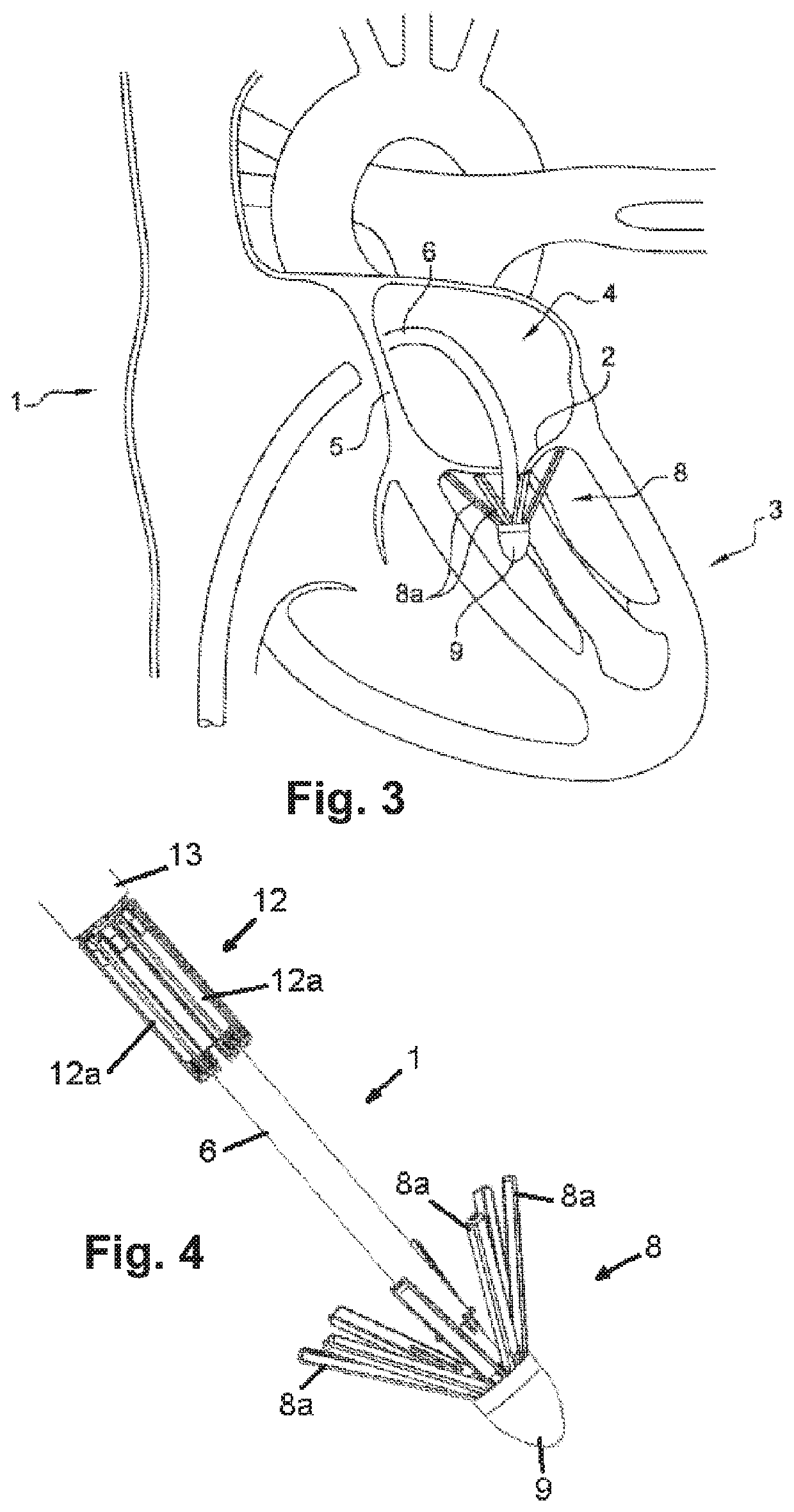 Device for performing or preparing for a mitral valve annuloplasty by a transfemoral approach