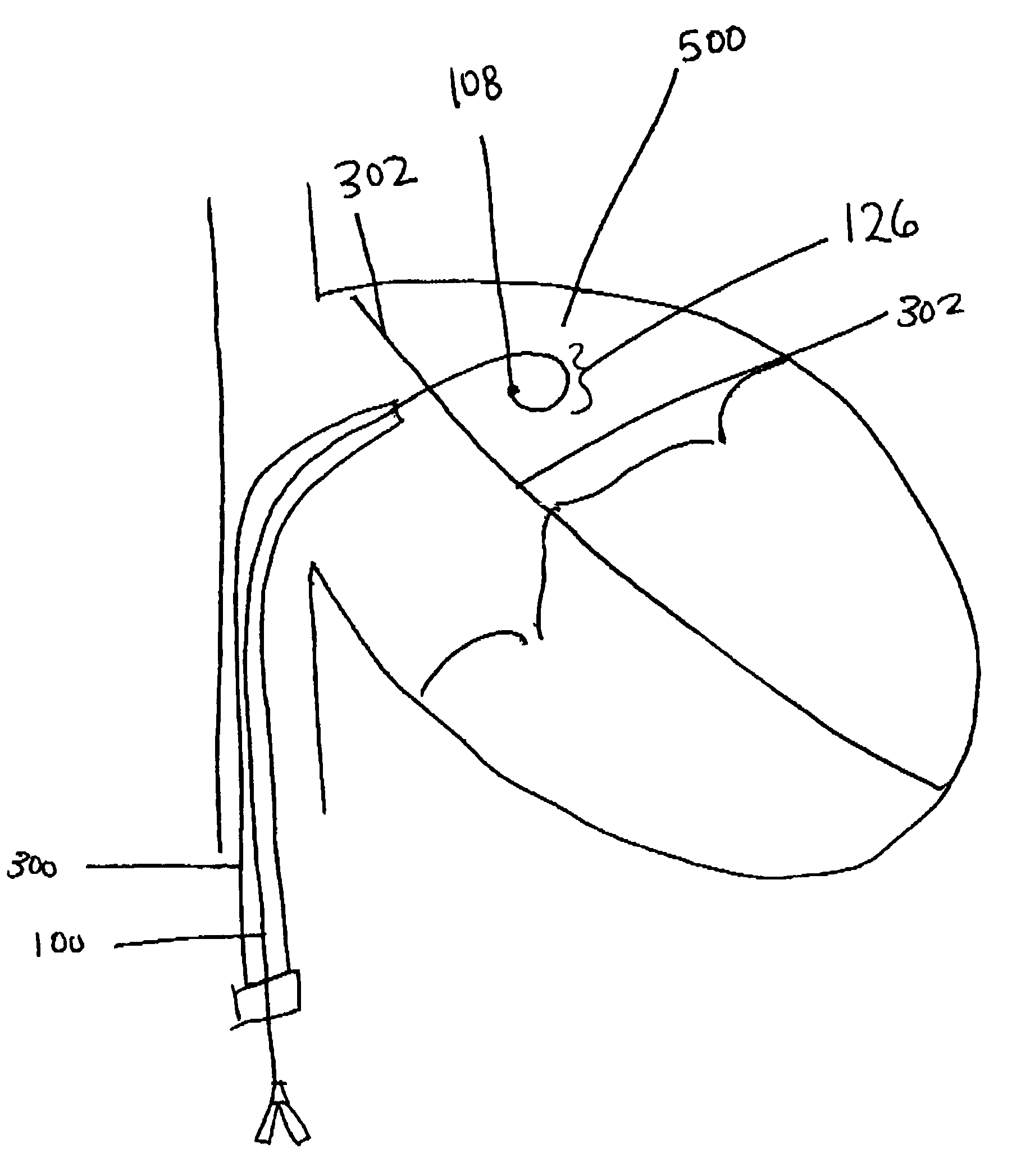 Surgical perforation device with curve