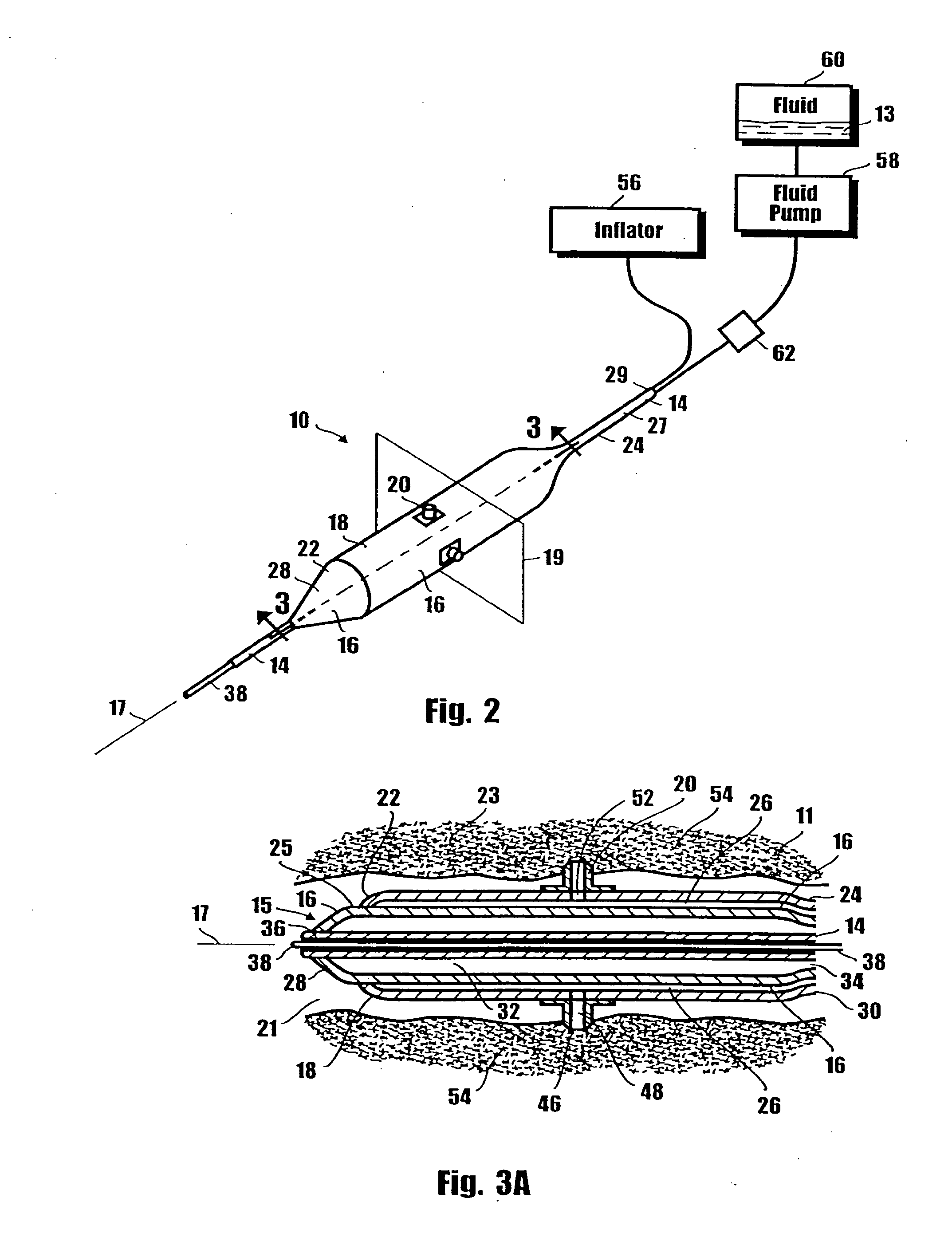 Method for delivering medication into an arterial wall for prevention of restenosis