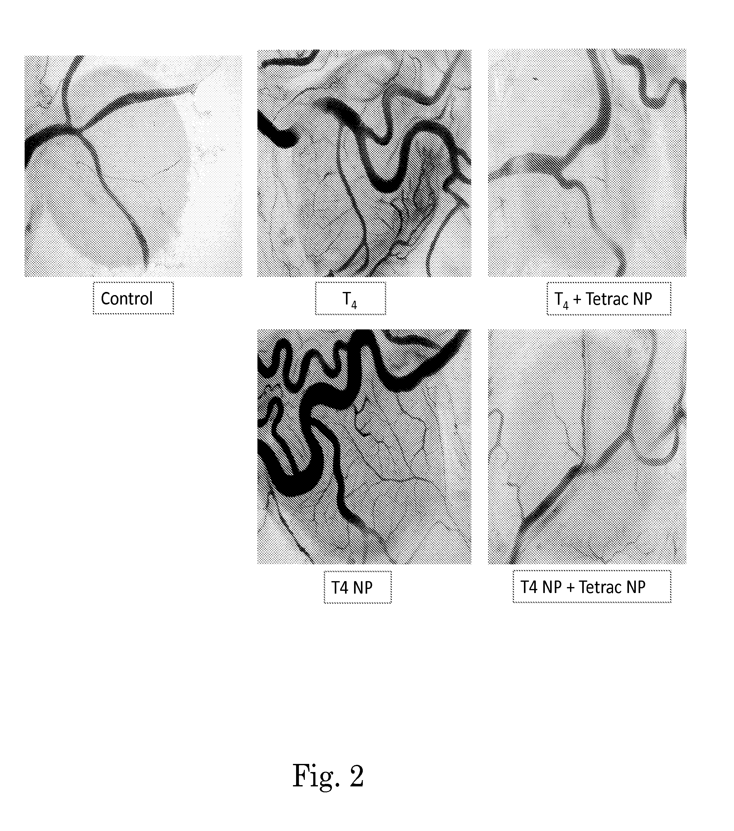 Methods for screening patients for resistance to angioinhibition, treatment and prophylaxis thereof
