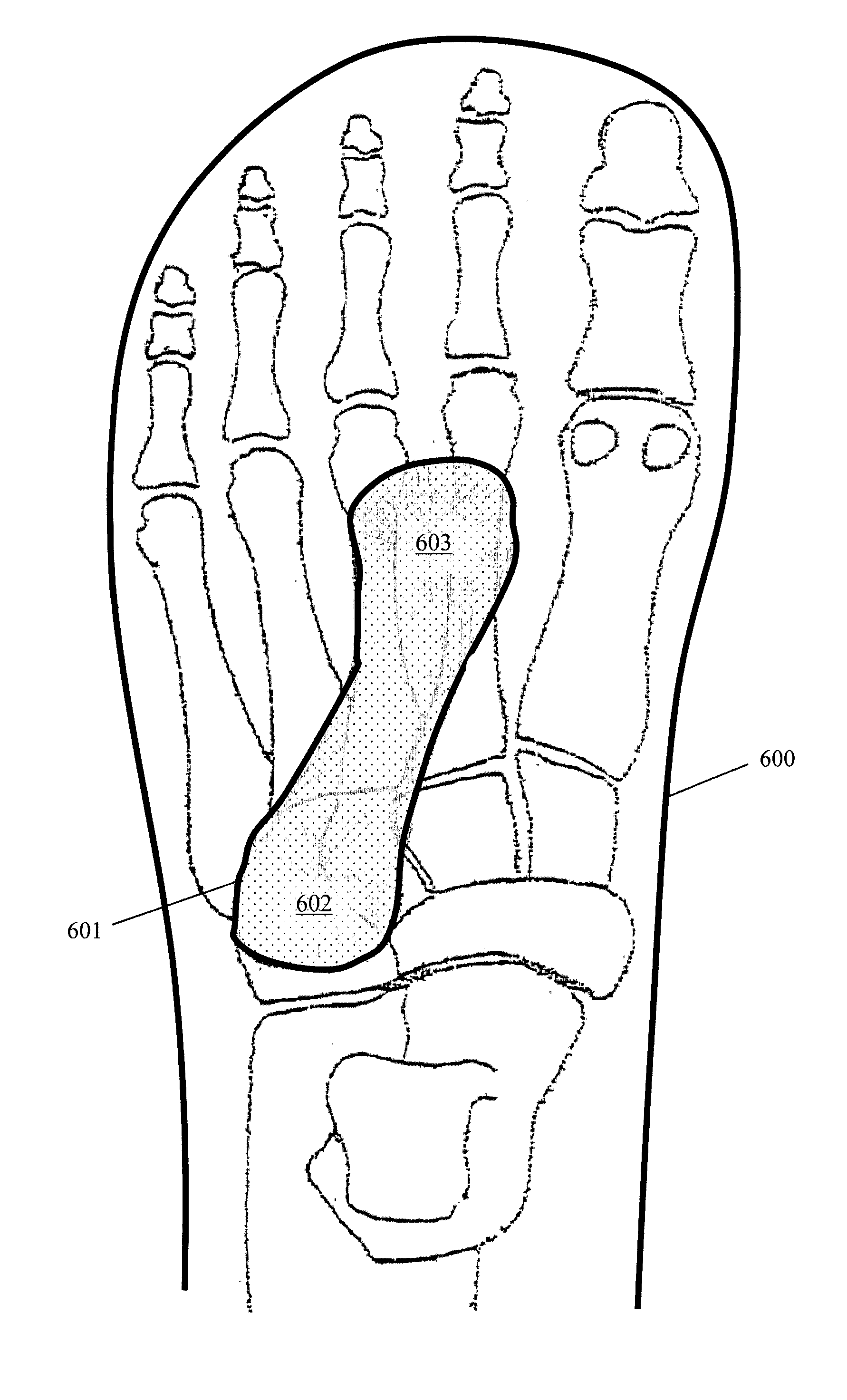 Shoe appliance with an orthopedic device