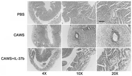 Application of interleukin-37b in preparation of product for preventing and treating Kawasaki disease