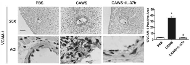 Application of interleukin-37b in preparation of product for preventing and treating Kawasaki disease