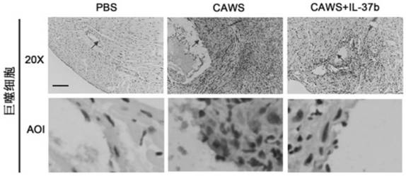 Application of interleukin-37b in preparation of product for preventing and treating Kawasaki disease