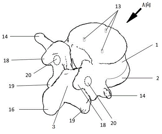 High-simulation customized combined artificial vertebra