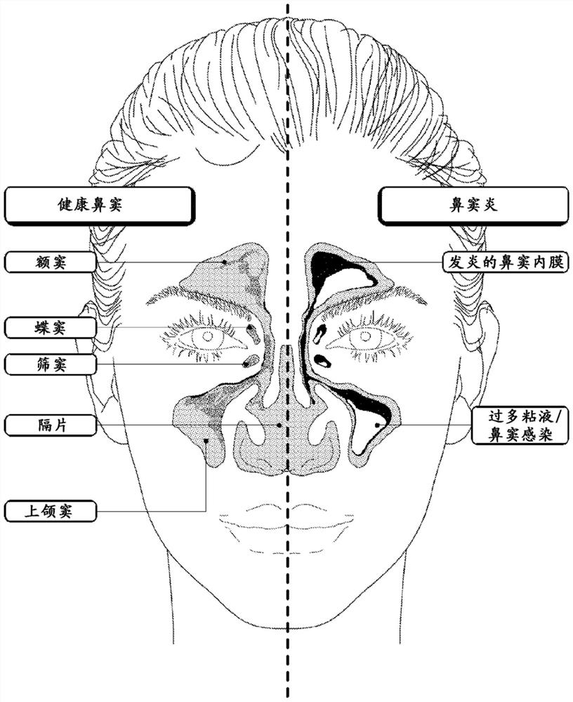 Device and method for sinusitis diagnosis