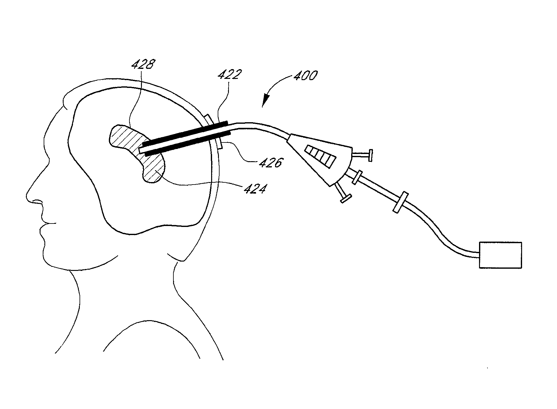 Method and apparatus for treatment of intracranial hemorrhages