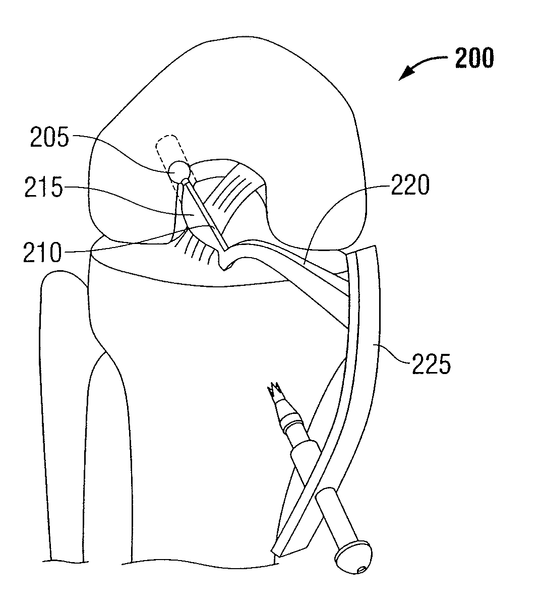 Tibial guide for ACL repair having left/right docking configuration