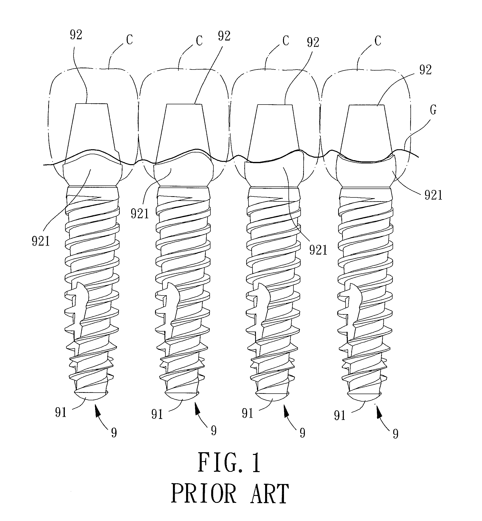 Dental implant with positioning marker and index portions