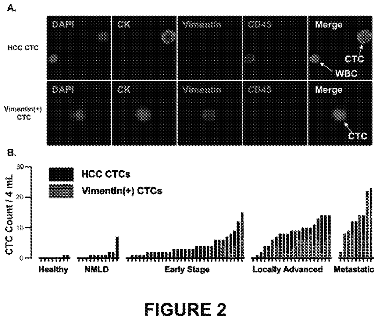Phenotypic profiling of hepatocellular carcinoma circulating tumor cells for treatment selection