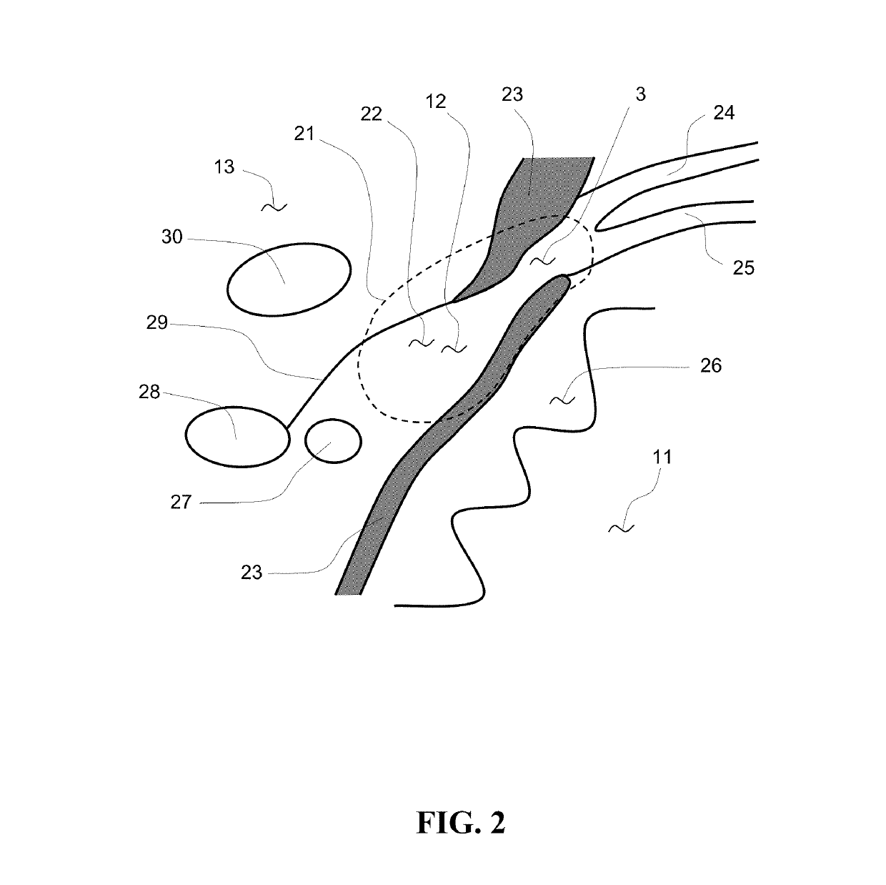 Single conduit multi-electrode cardiac pacemaker and methods of using thereof