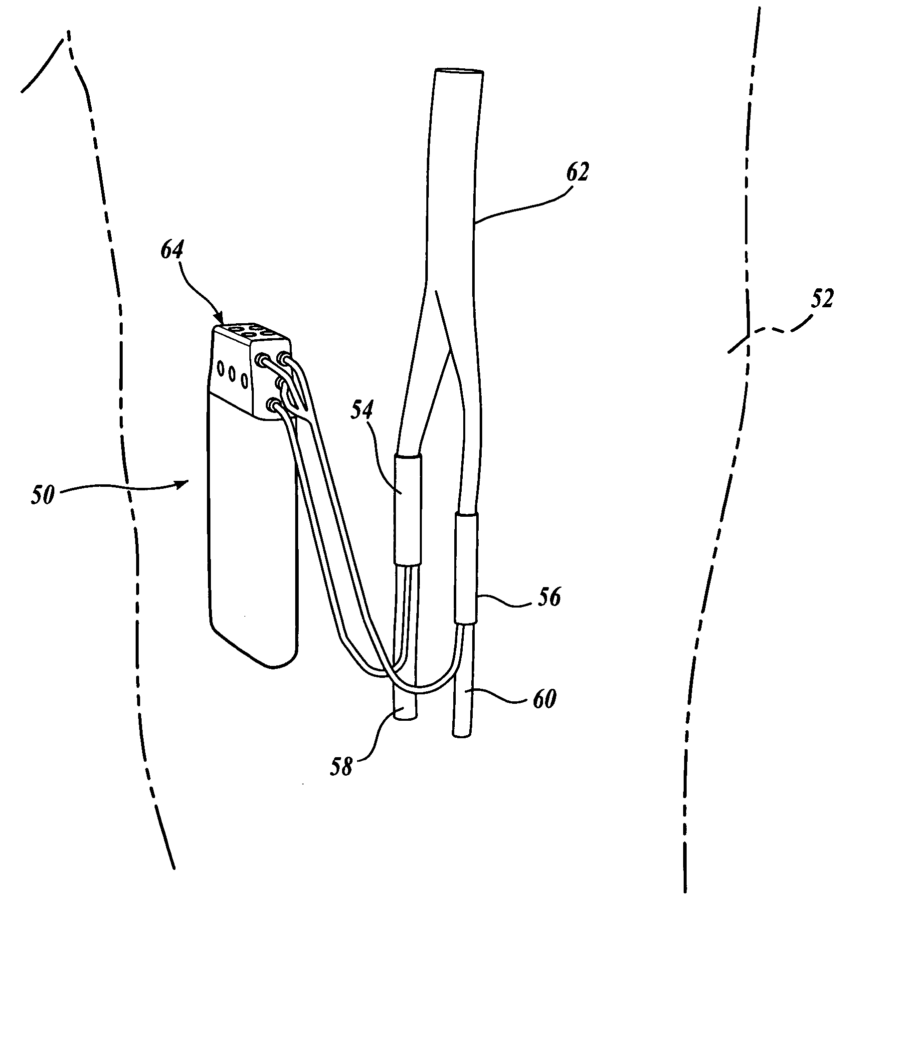 Fully implantable nerve signal sensing and stimulation device and method for treating foot drop and other neurological disorders