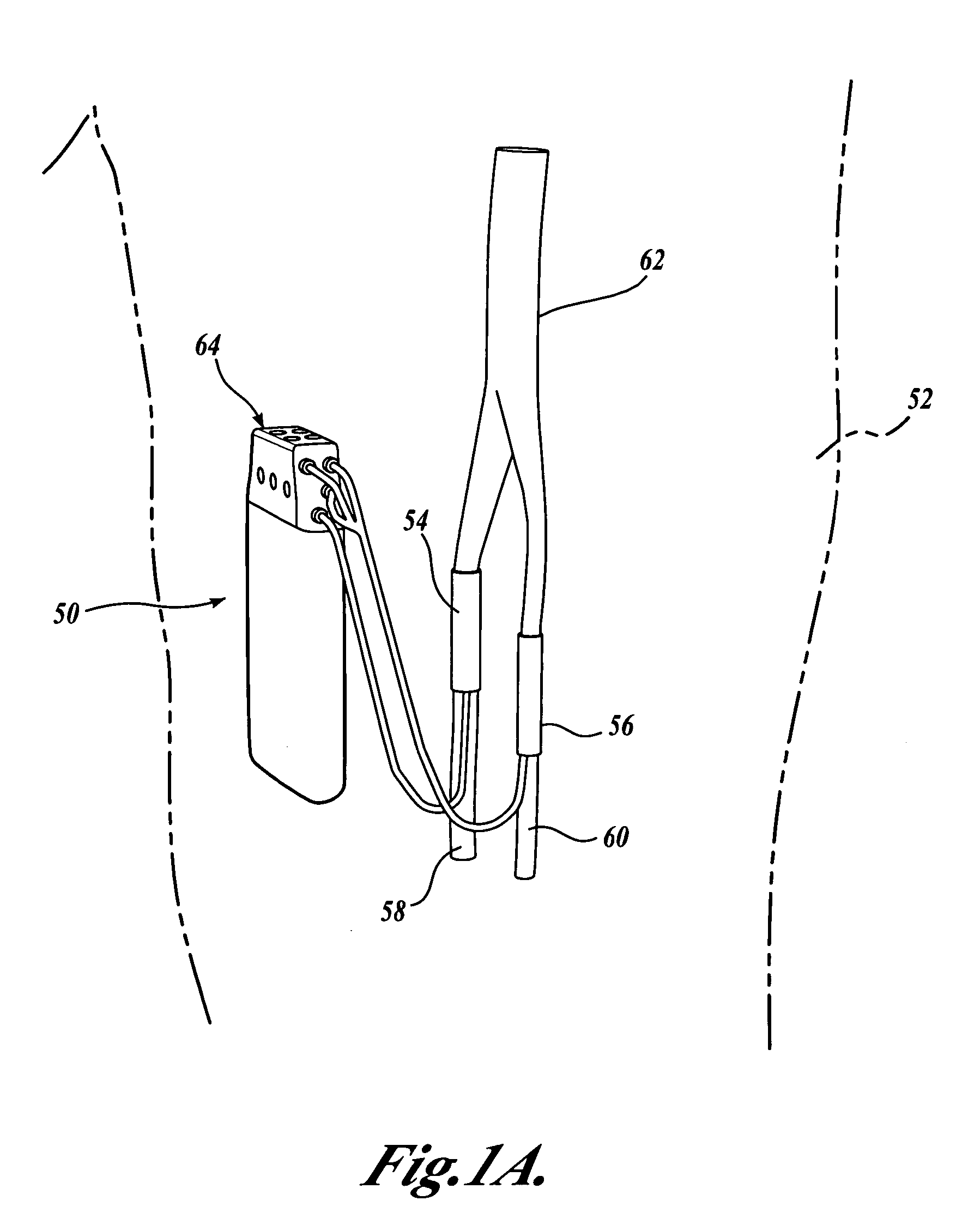 Fully implantable nerve signal sensing and stimulation device and method for treating foot drop and other neurological disorders