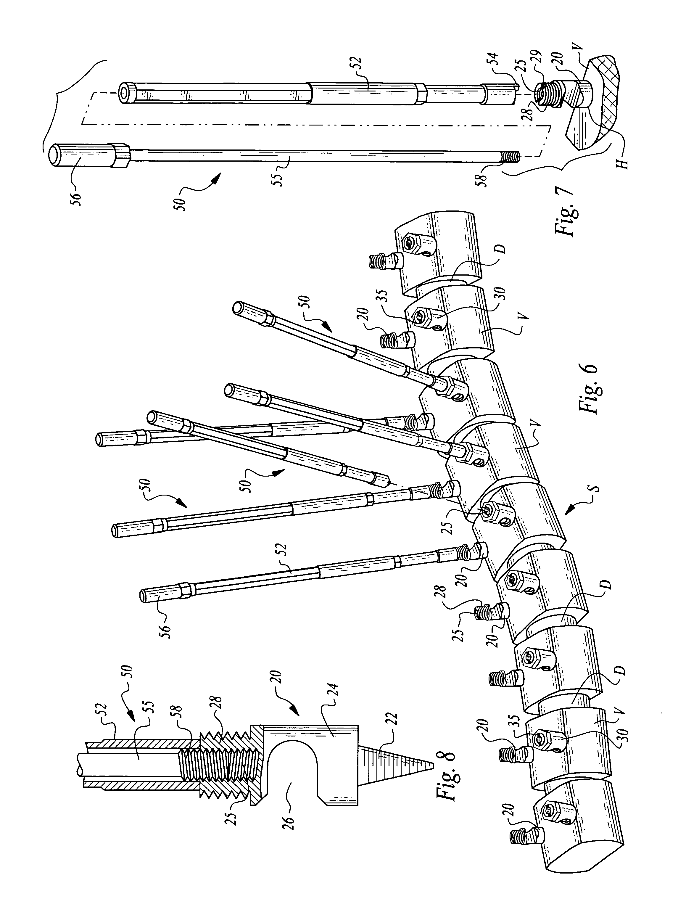 Scoliosis de-rotation system and method