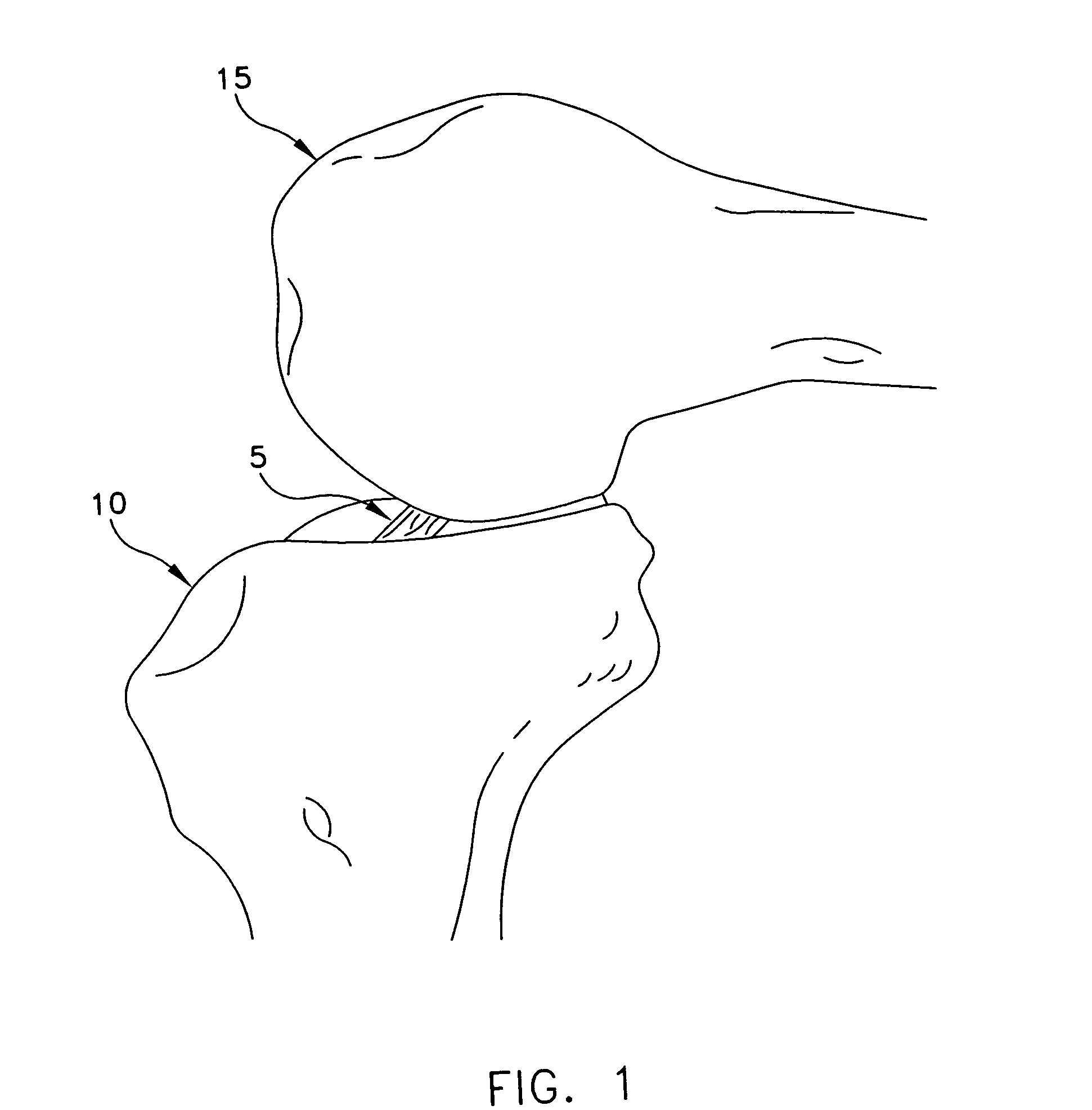 Apparatus and method for reconstructing a ligament