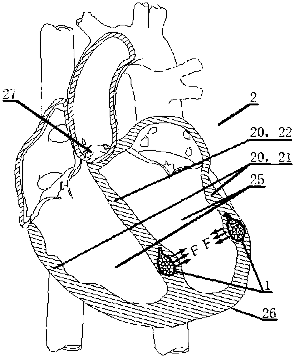Ventricle assisting device implanted through interventional micro-injury operation