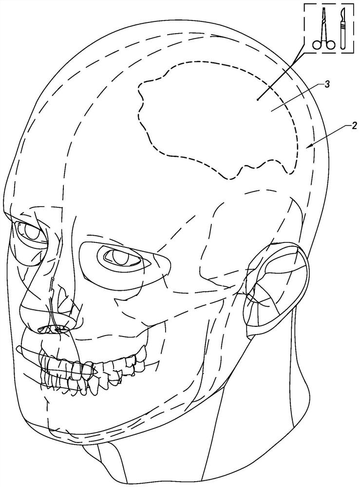Skull implant
