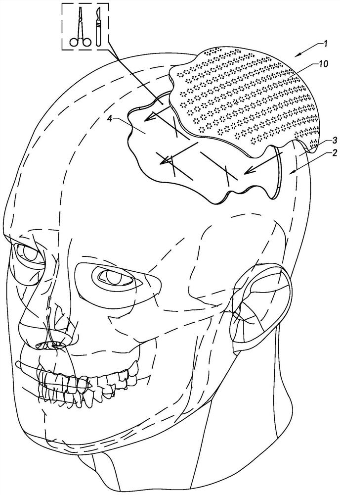 Skull implant