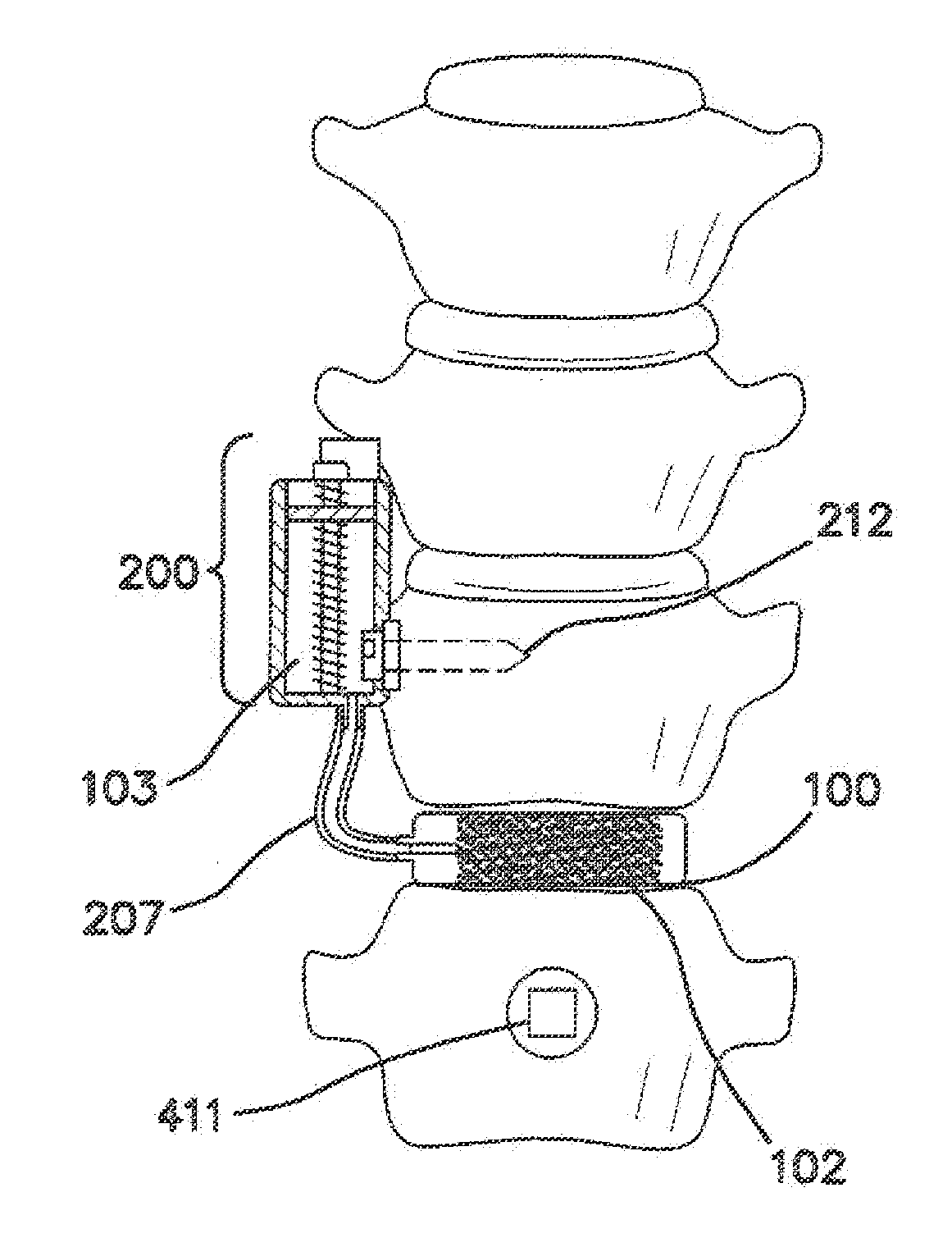 Remotely Activated Piezoelectric Pump for Delivery of Biological Agents to the Intervertebral Disc and Spine