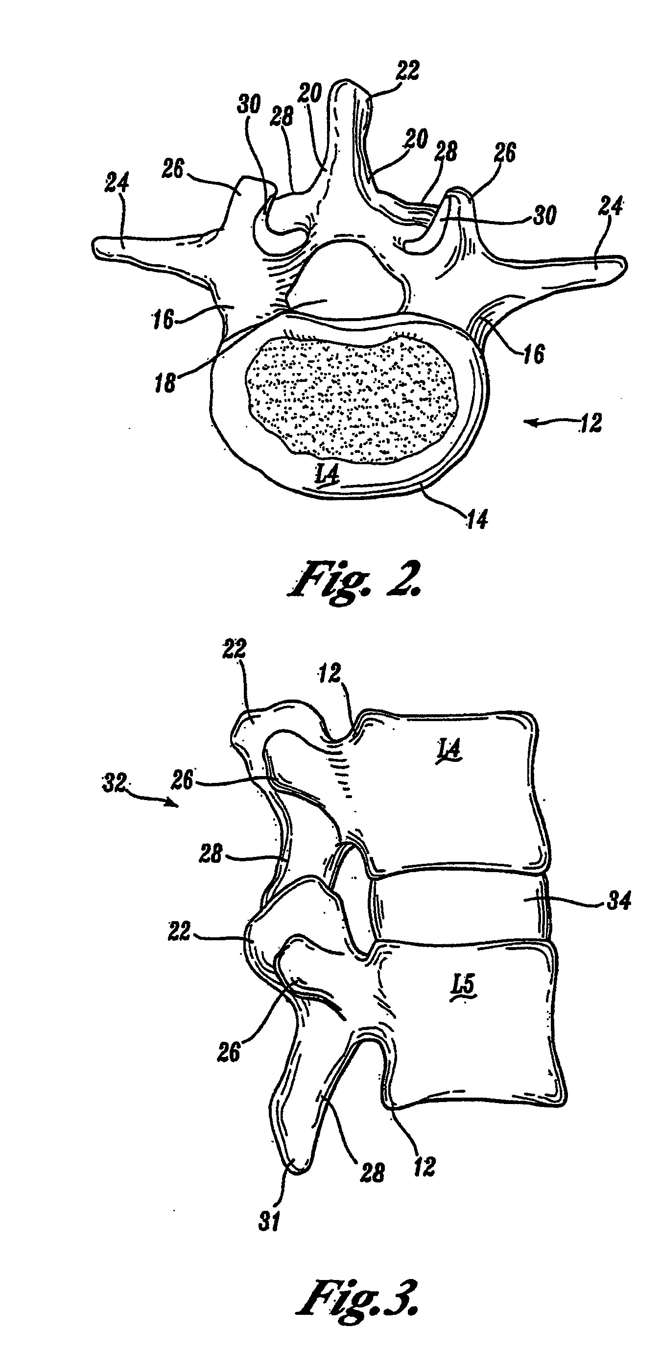 Prostheses, tools and methods for replacement of natural facet joints with artificial facet joint surfaces