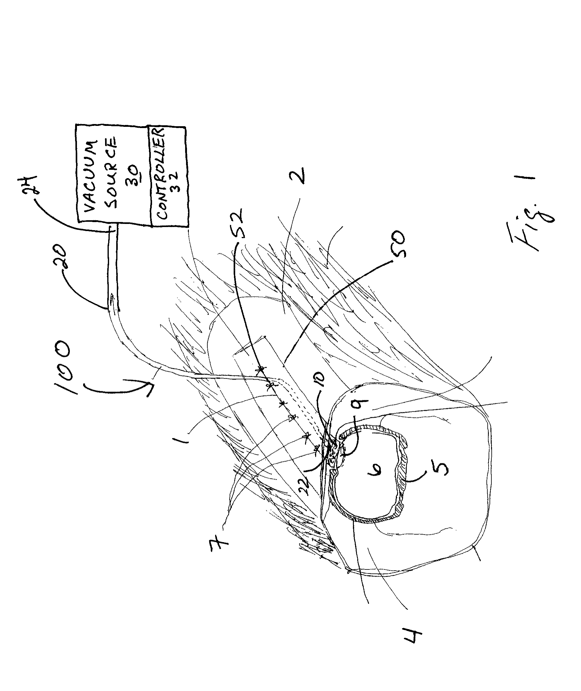 Device and method for treating central nervous system pathology