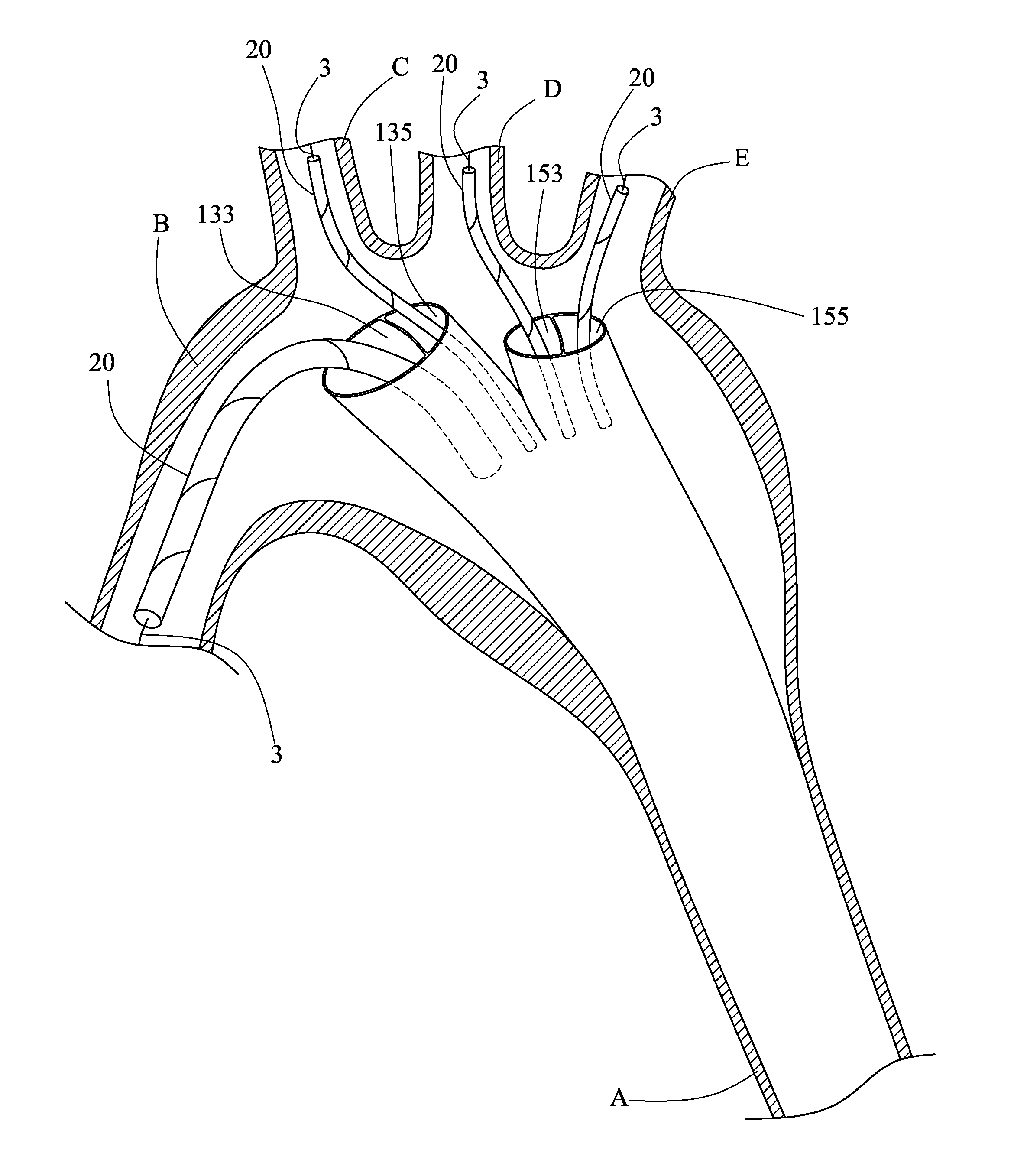 Method of implanting an aortic stent