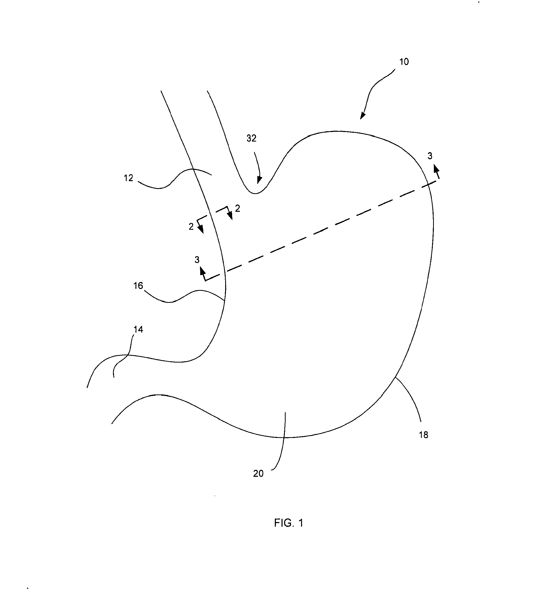 Device and Method for Endoluminal Therapy