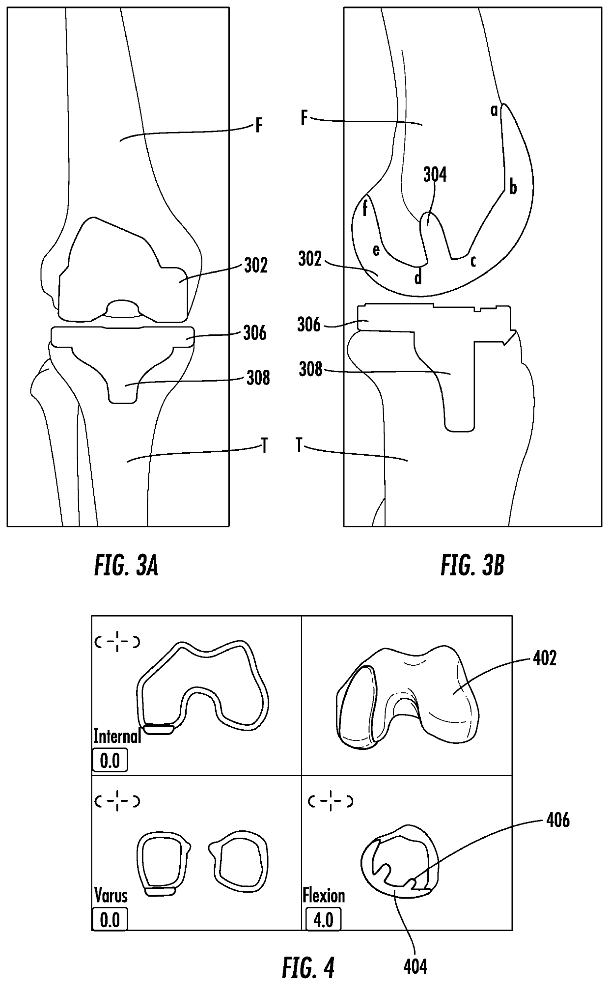 Systems and methods for a robotic-assisted revision procedure