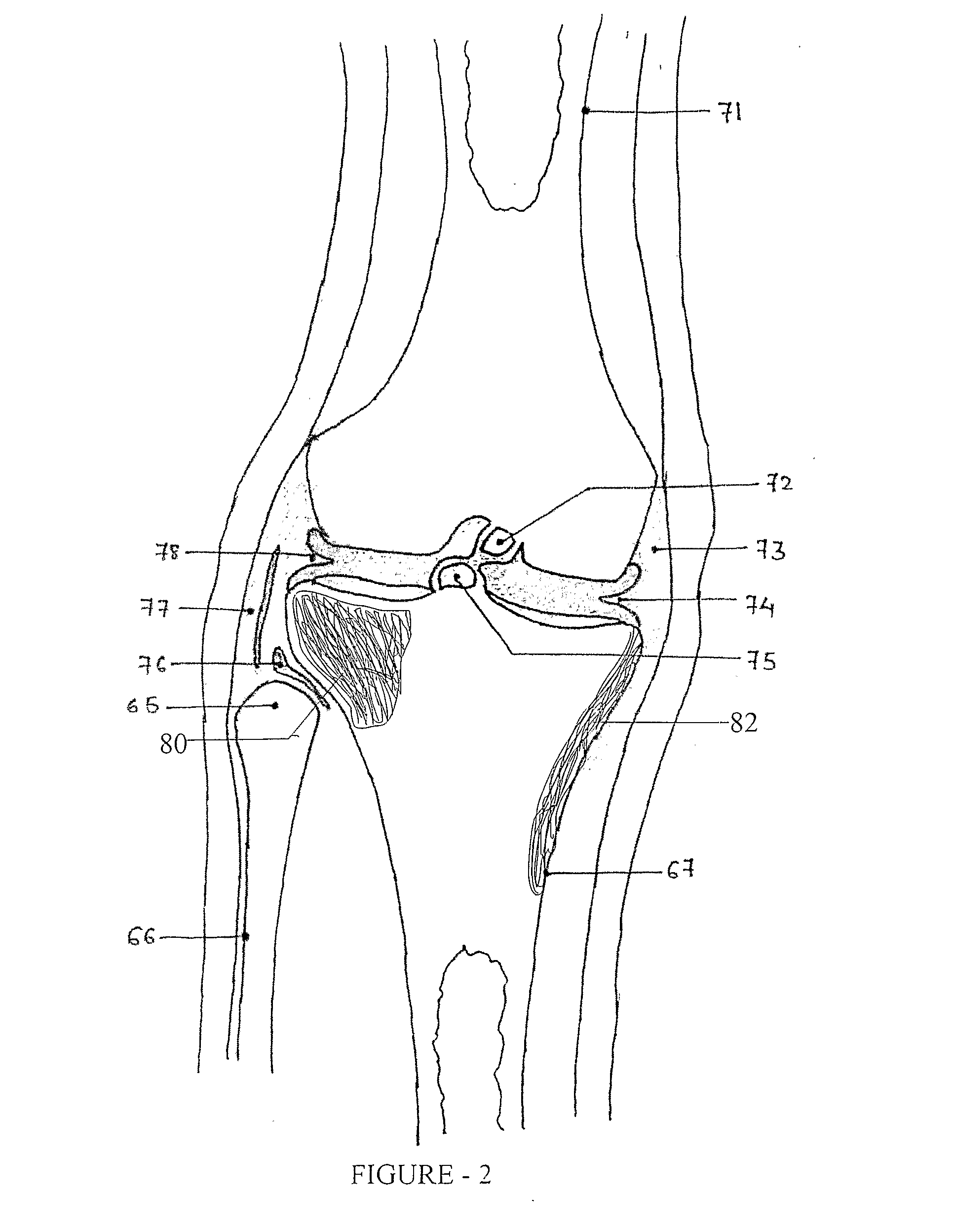 Knee Joint Prosthesis