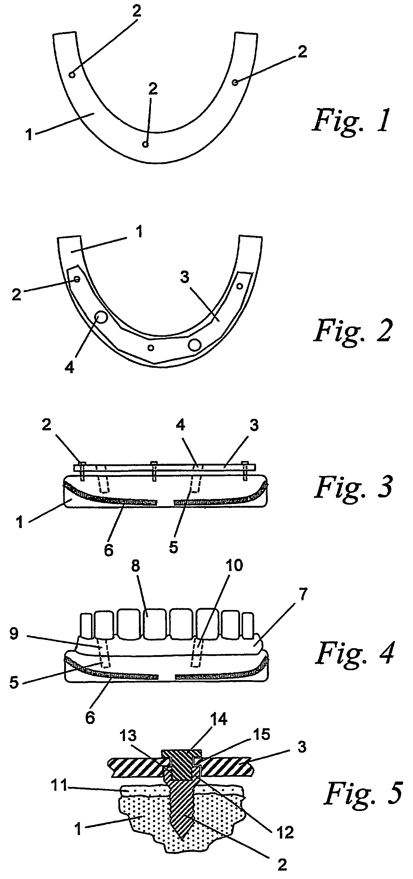 Method for manufacturing a suprastructure and a corresponding drill jig