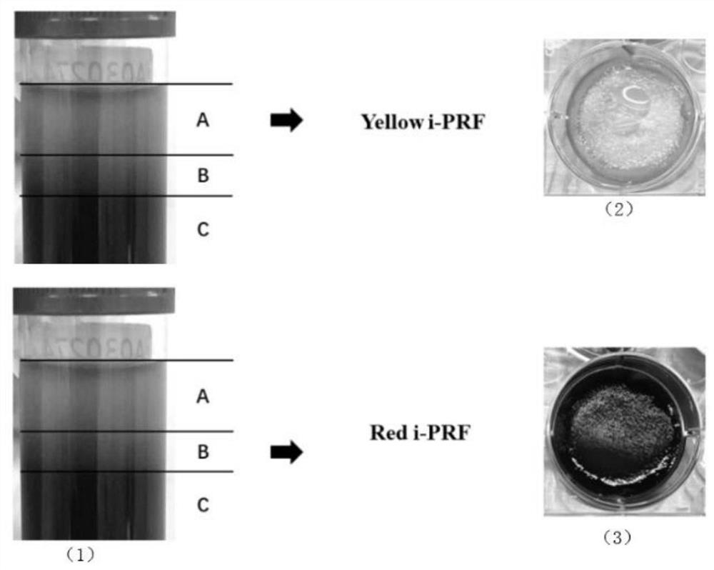 Red platelet-rich fibrous protein biological injection material and application thereof