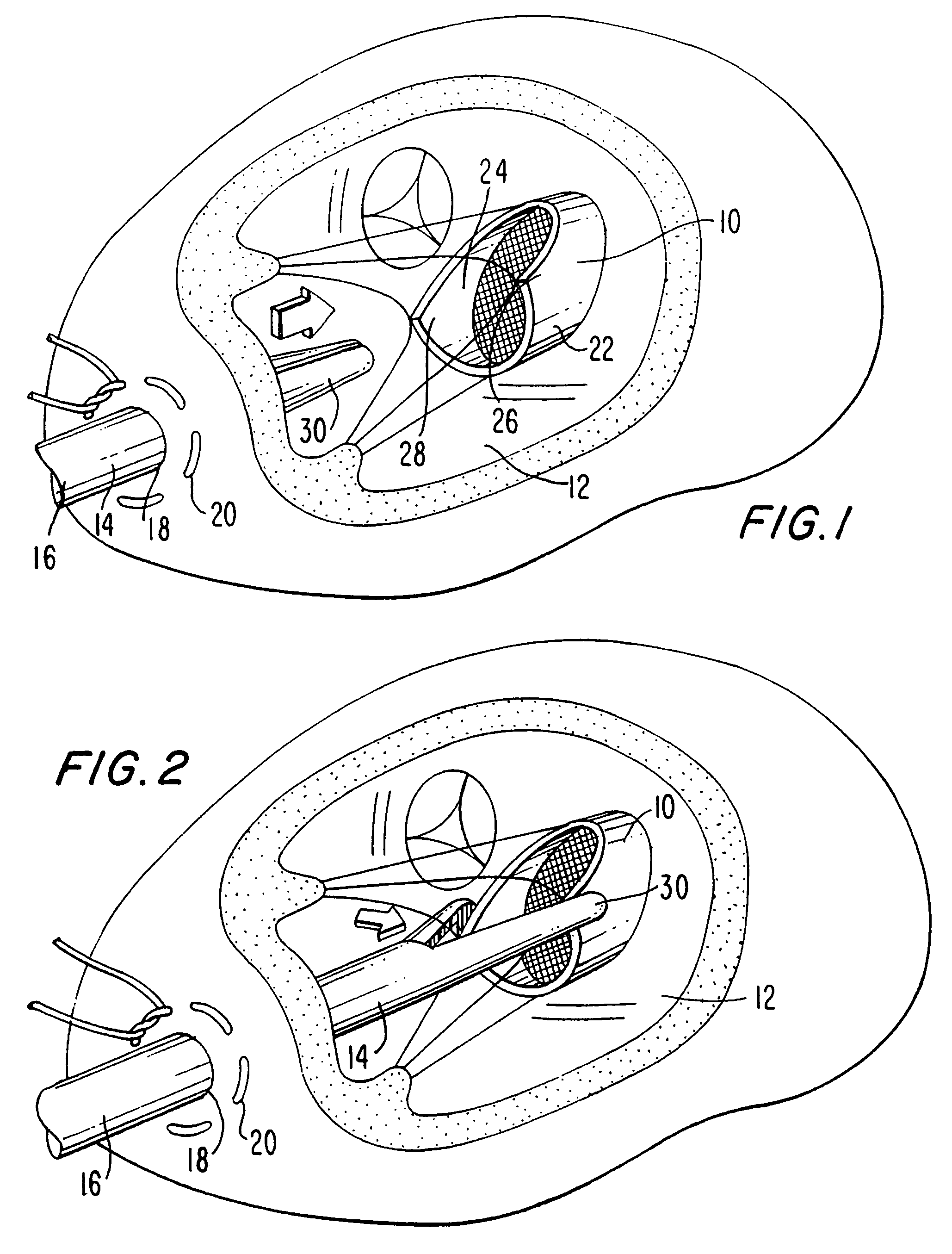 Method and apparatus for circulatory valve repair