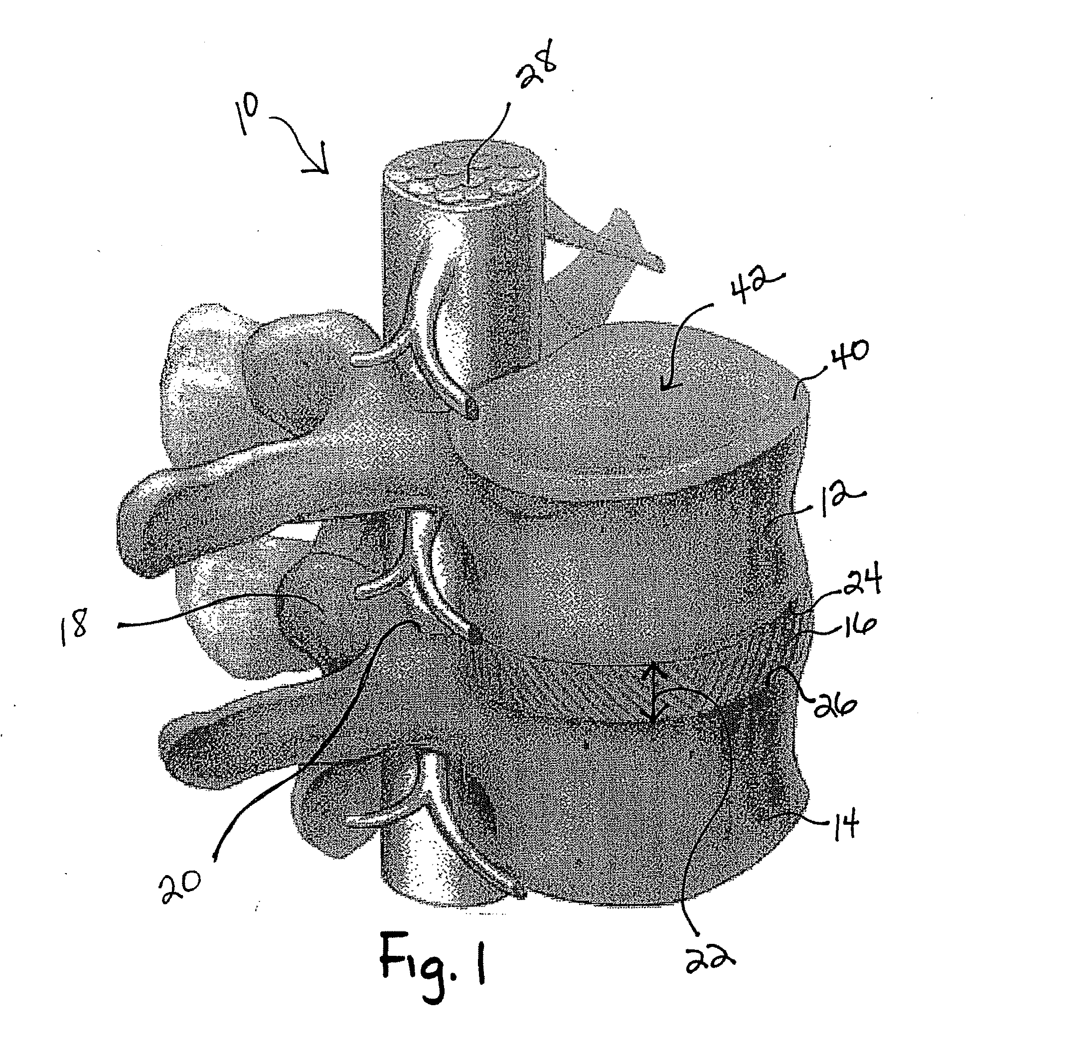 Spine surgery method and implant