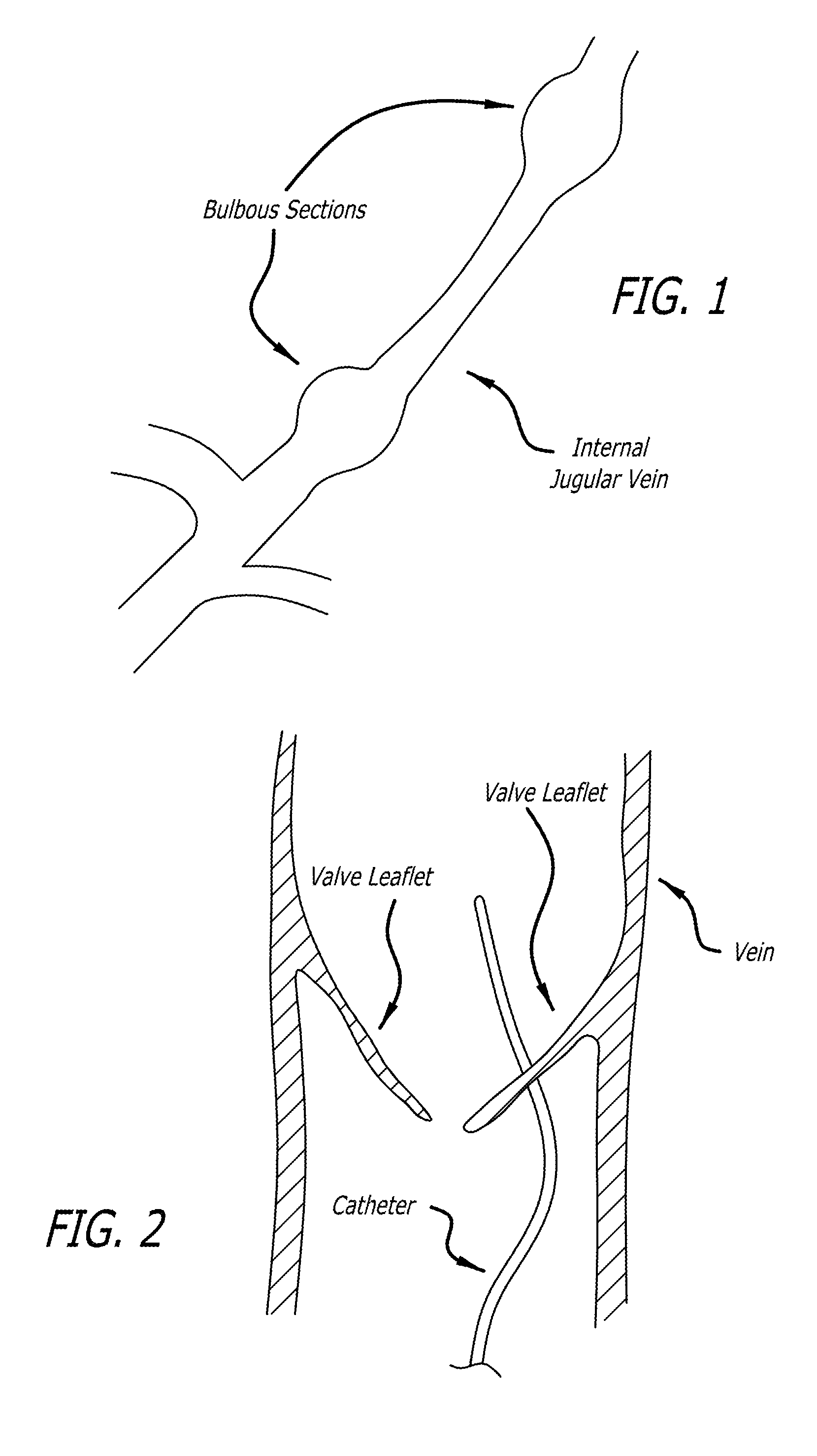 Method of fabricating an intraluminal scaffold with an enlarged portion