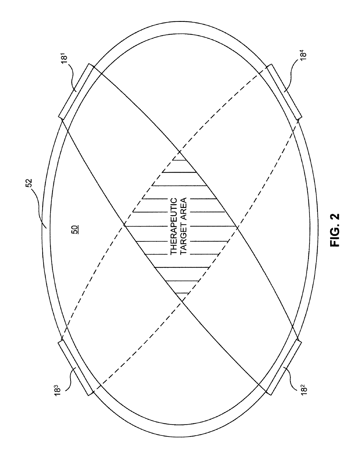 System and method employing interferential electrical stimulation to treat cardiac issues
