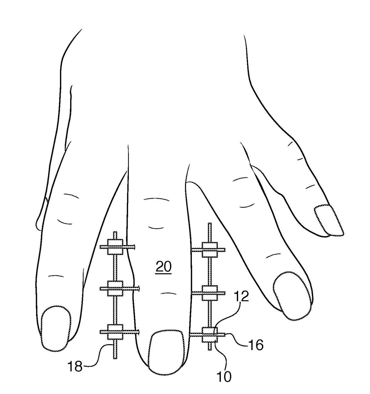 Bracket for external fixation of bones