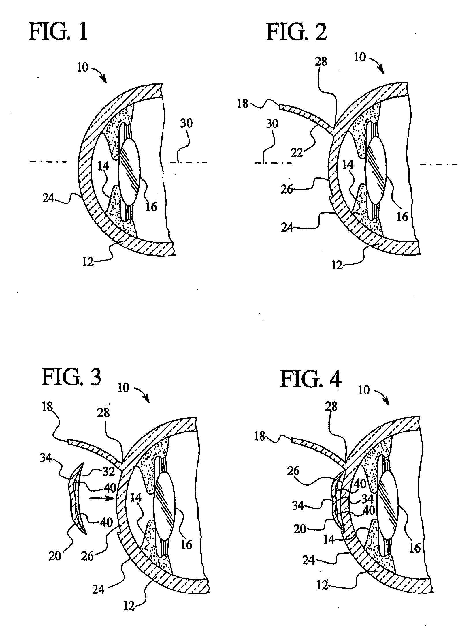 Method of treating the eye using controlled heat delivery