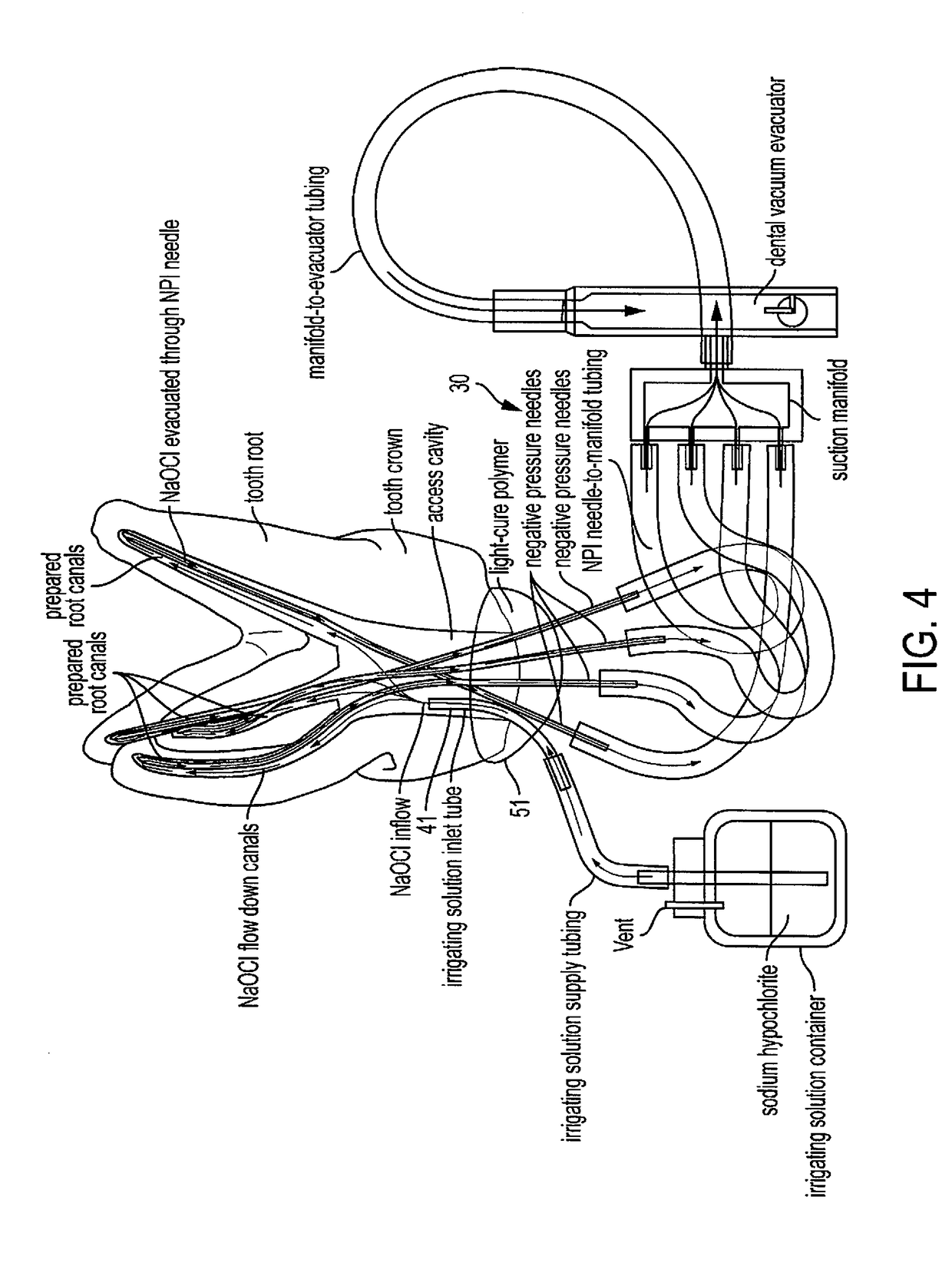 Multi-Cannula Negative Pressure Irrigation System